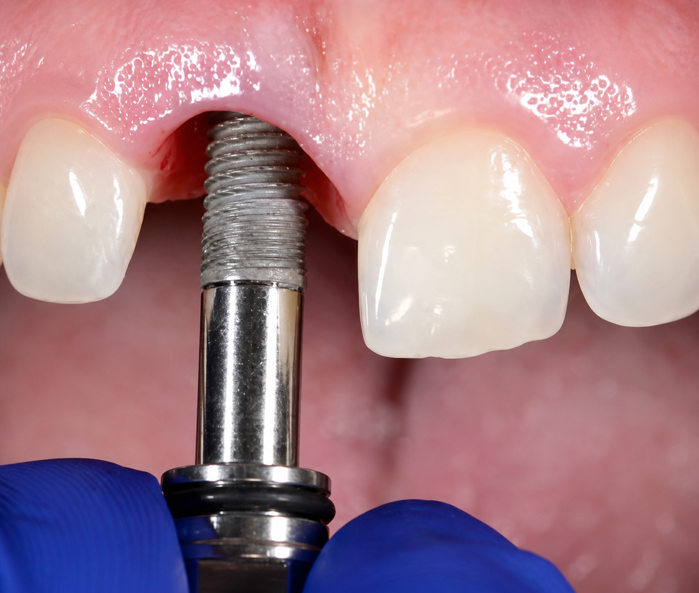 Advanced Implant Rehabilitation Experience