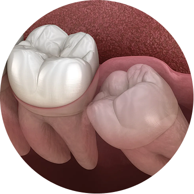 Wisdom Teeth Training