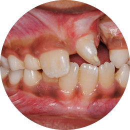 Maxillofacial Anomalies