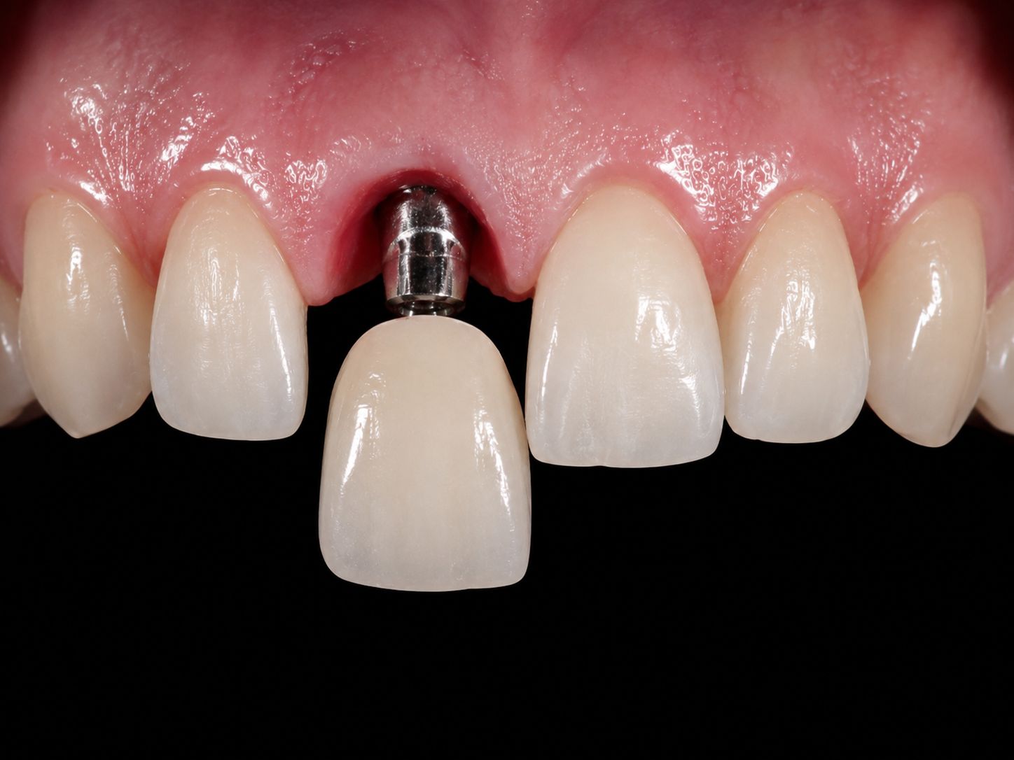 Advanced Implant Rehabilitation Experience