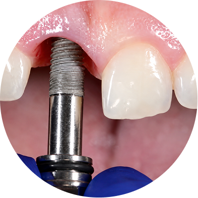 Advanced Implant Rehabilitation Experience