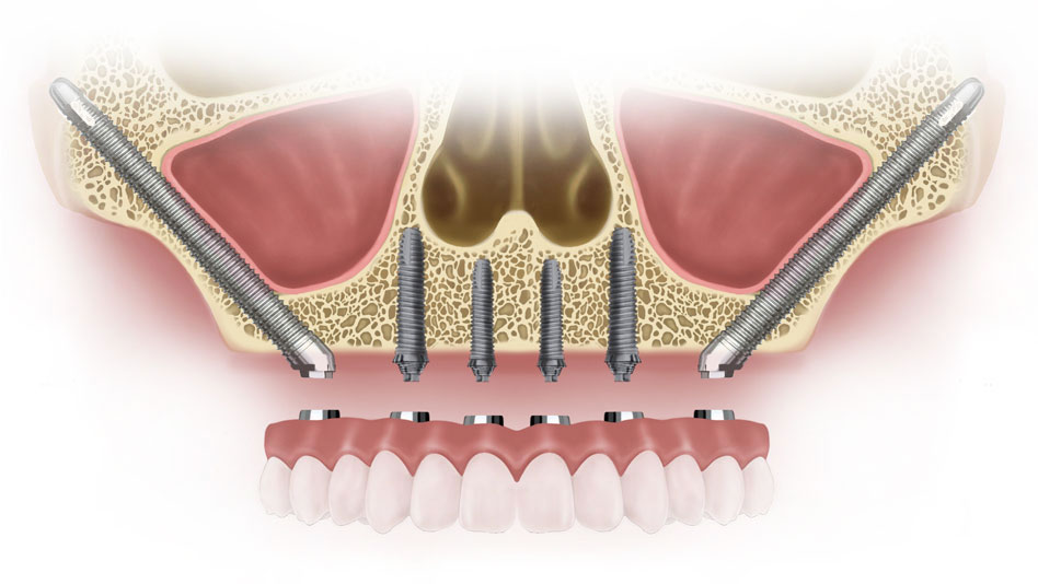 Why Can Taking the Best Zygomatic Implant Course Enhance Your Skills in Full-Arch Restorations?