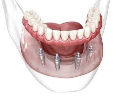 Hands-On Dental Implant Training: Live Surgery Course for USA Dentists