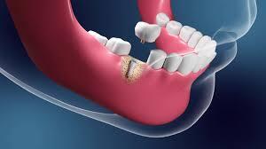 Delving into the world of live surgery and implant dentistry- a beginner’s intrusive guide