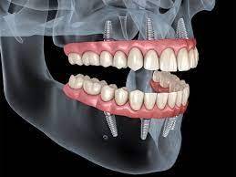 Maximize Your Career with Hands-On Dental Implant Training