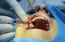 Benefits to reap from Dental implant training for USA and other foreign dentists