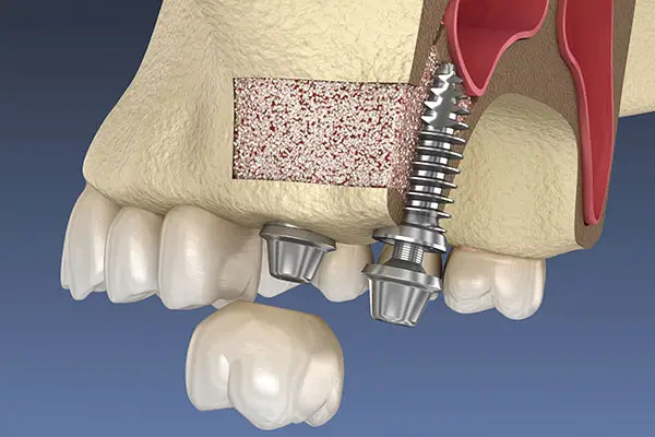 What Is Guided Bone Regeneration (GBR) and Why Should Dentists Master It?