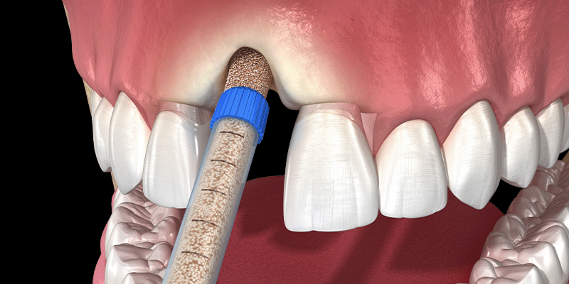 Why Every Dentist Should Take a PRF Course: The Future of Regenerative Dentistry?