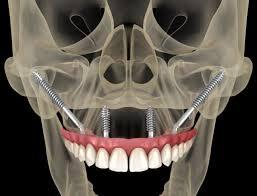 Why Zygomatic Implants Are the Future of Full-Arch Restorations?