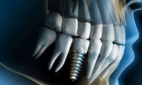 How Implant Dentistry Courses Bridge the Gap from Theory to Practice?