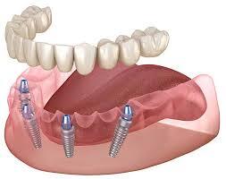 How Live Patient Courses Provide Real-World Implant Surgery Experience?