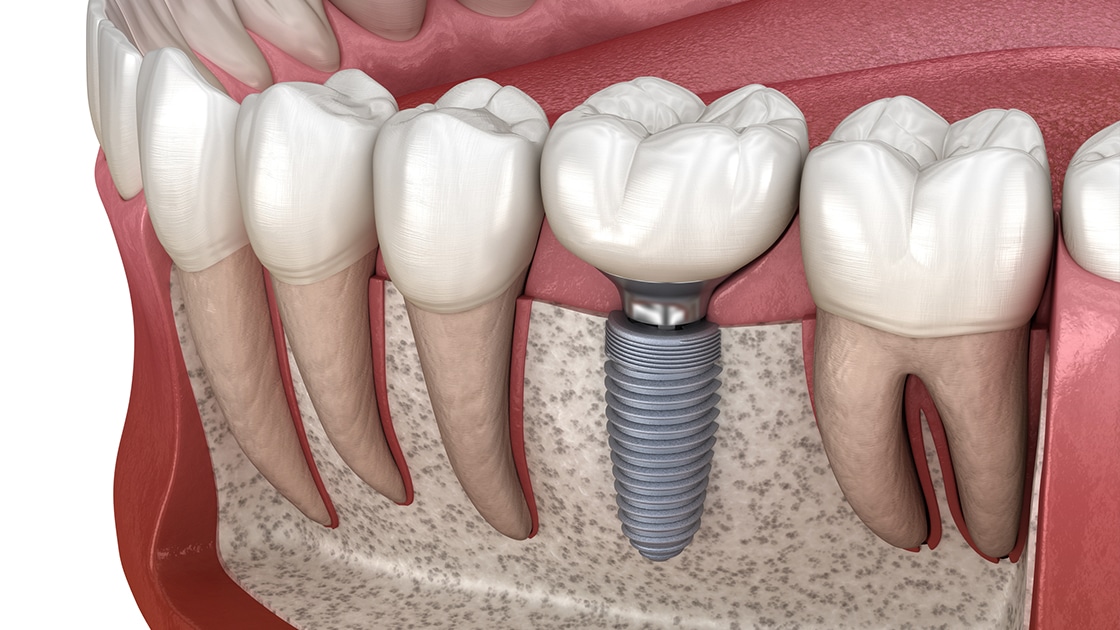 Elevate Your Career with the Top Dental Implant Course for USA and Foreign Dentists