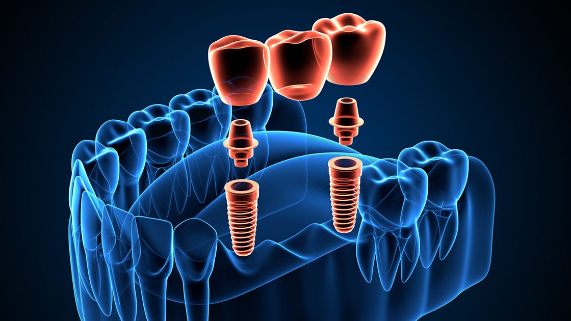 Elevate Your Expertise with Premier Dental Implant Training for USA and Foreign Dentists