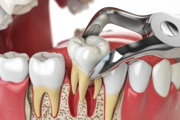 Elevate Your Expertise with the Top Third Molar Extraction Training in Brazil by Expert Dental Solutions