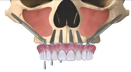 Discover the Best Zygomatic Implant Course with Expert Dental Solutions