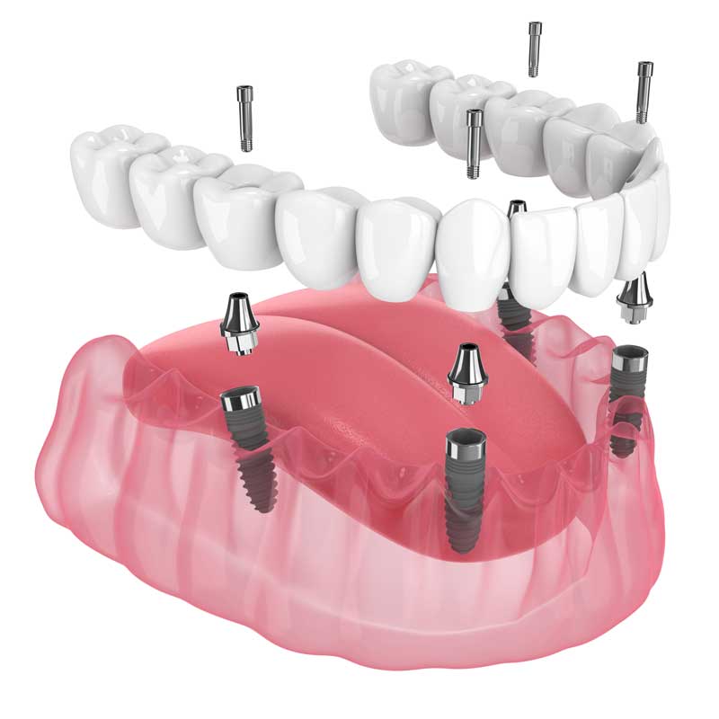 Master Full Arch Restorations with World-Class Training for USA and Foreign Dentists