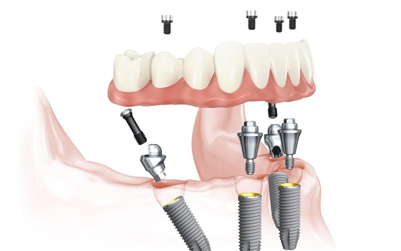 Master Precision with the Ultimate Implant Placement Course by Expert Dental Solutions