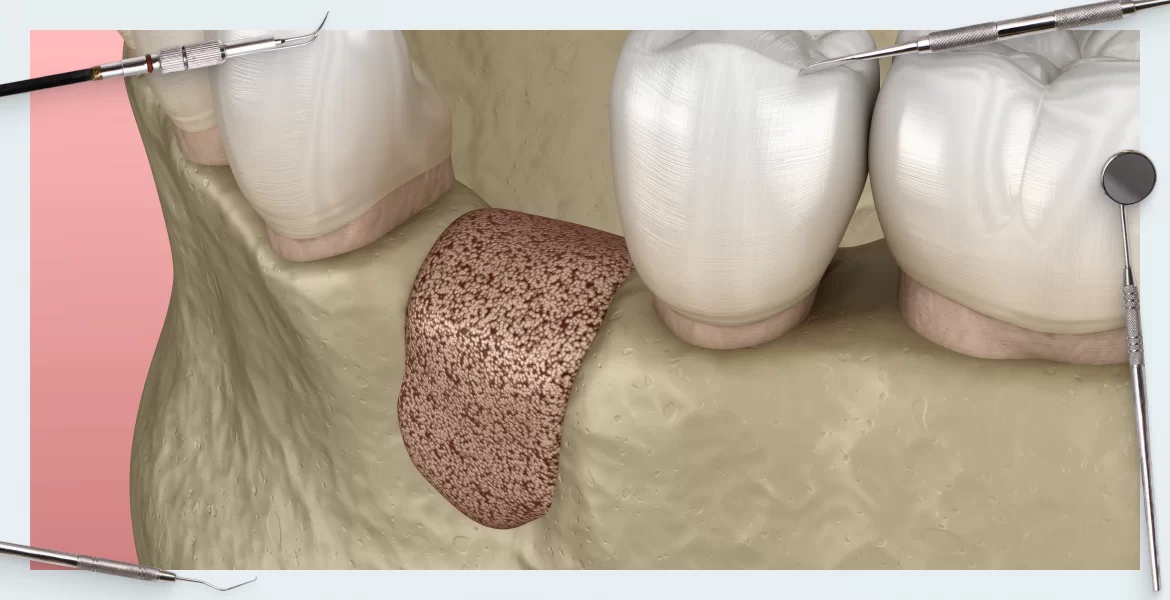 Unlock Expertise with the Affordable Guided Bone Regeneration Course by Expert Dental Solutions