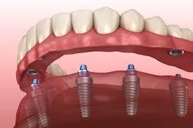 Unlock Your Potential with the Best Implant Dentistry Course in USA at Expert Dental Solutions
