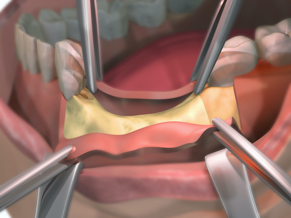 What Is Periodontal Plastic Surgery and Why Every Dentist Should Learn It