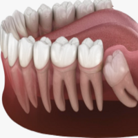 Third Molar Extractions: Understanding the Standard of Care in Wisdom Teeth Surgery