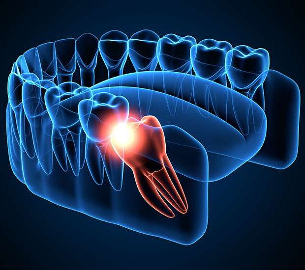 Understanding Wisdom Teeth Surgery: What Dentists Need to Know About Third Molar Extractions